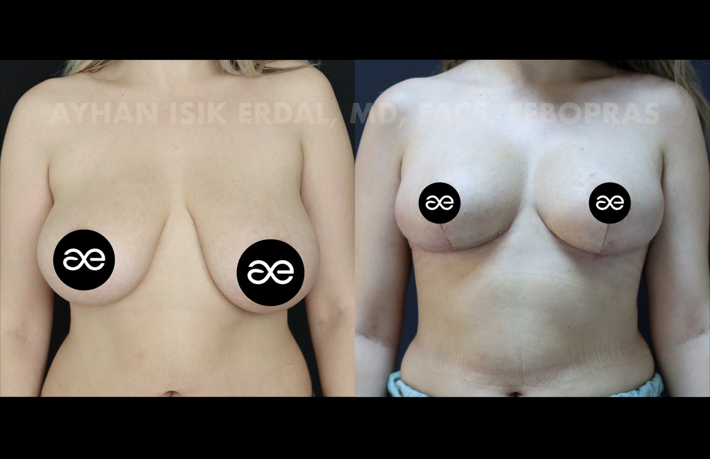 Case 1 frontal view - pre-op and 2 months post-op