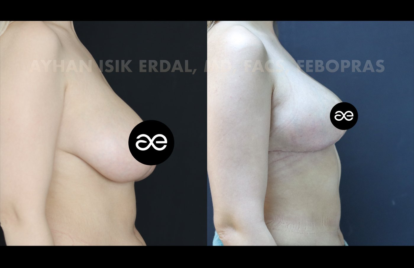 Case 1 lateral view - pre-op and 2 months post-op