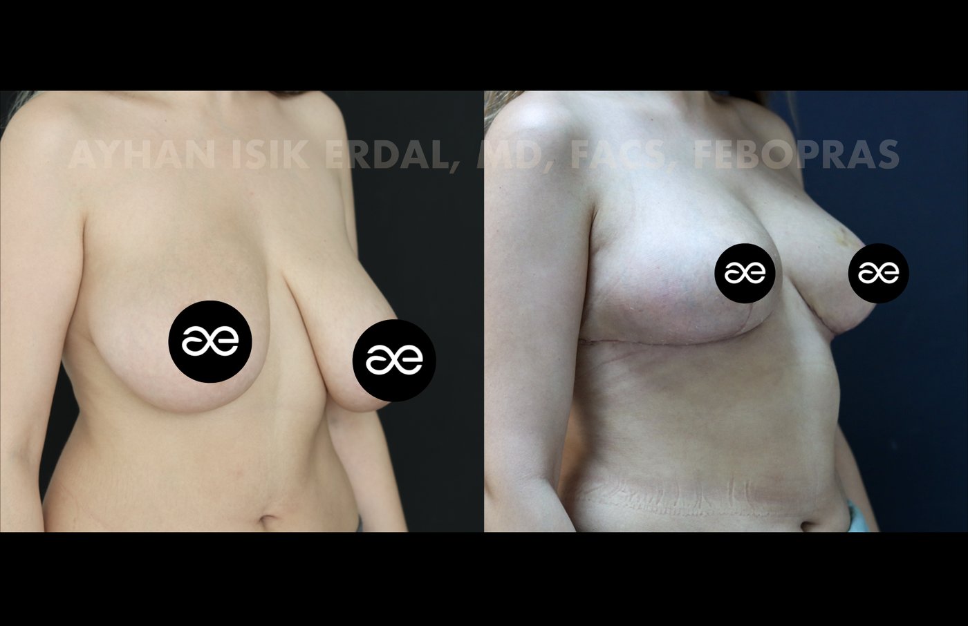 Case 1 oblique view - pre-op and 2 months post-op