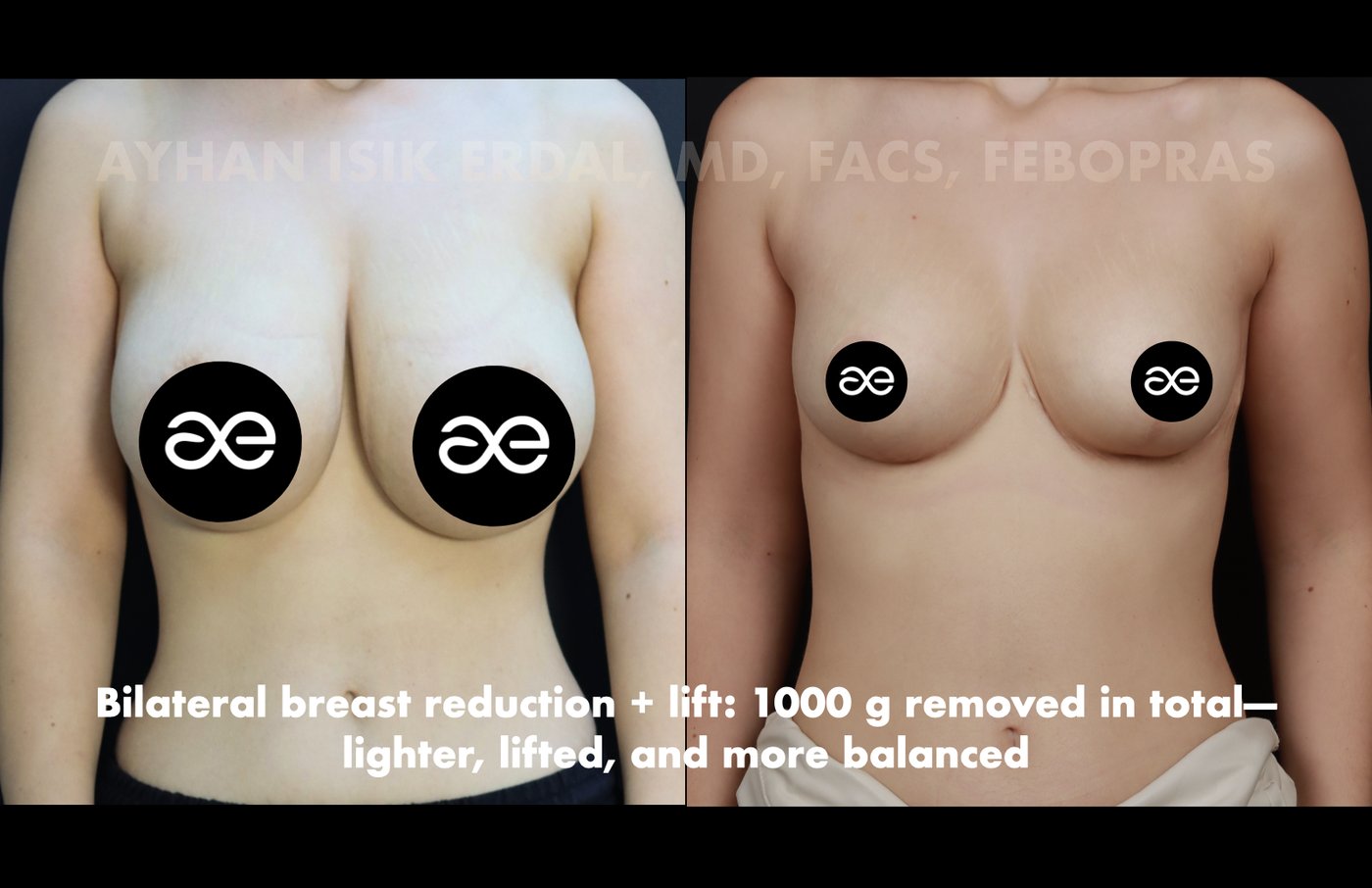 Case 2 frontal view - pre-op and 2 months post-op