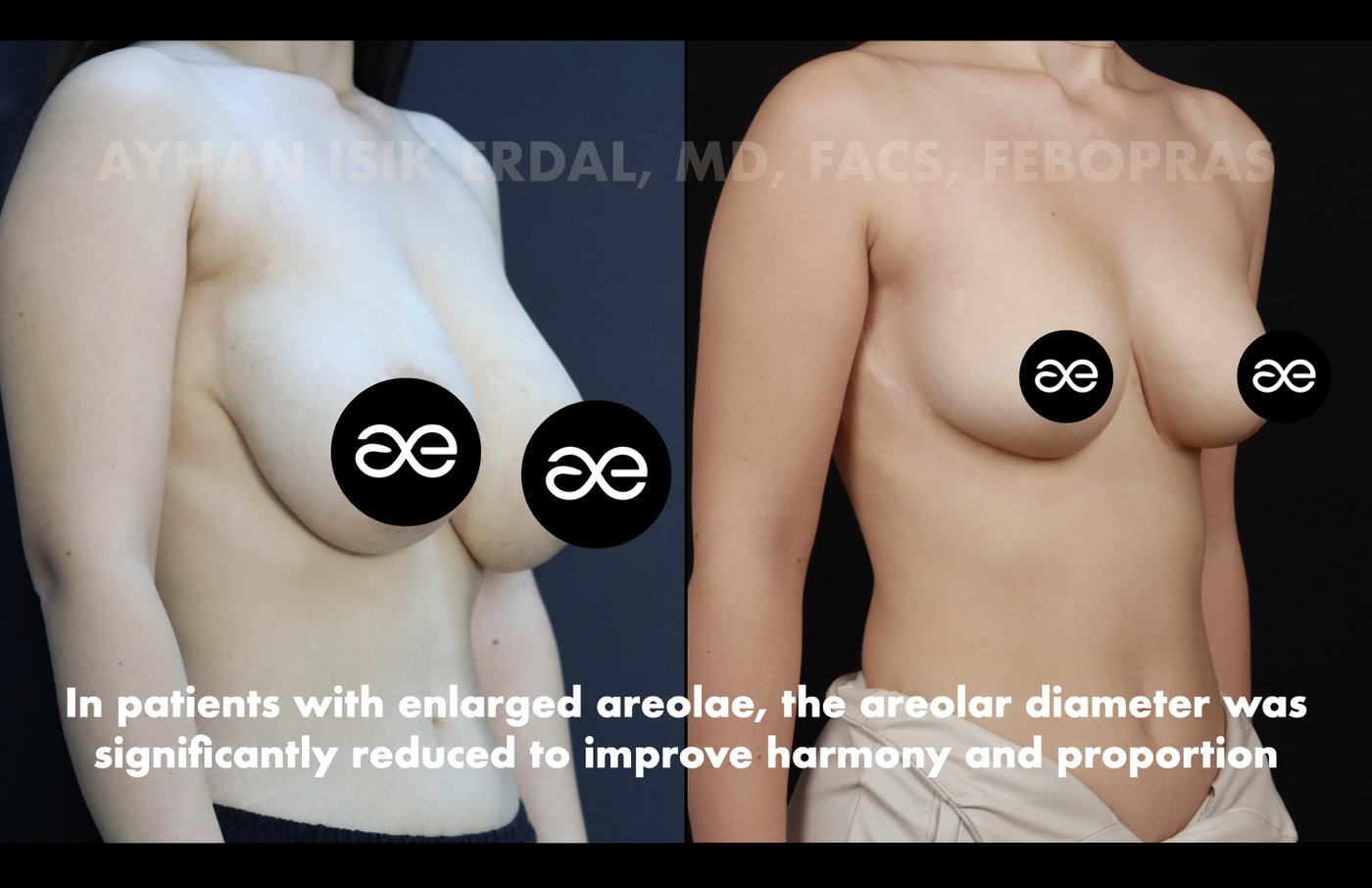 Case 2 lateral view - pre-op and 2 months post-op