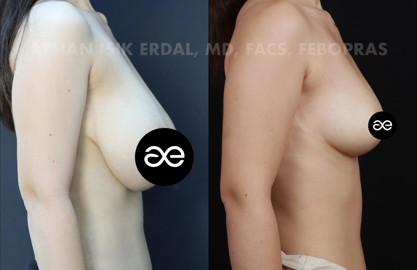 Case 2 oblique view - pre-op and 2 months post-op