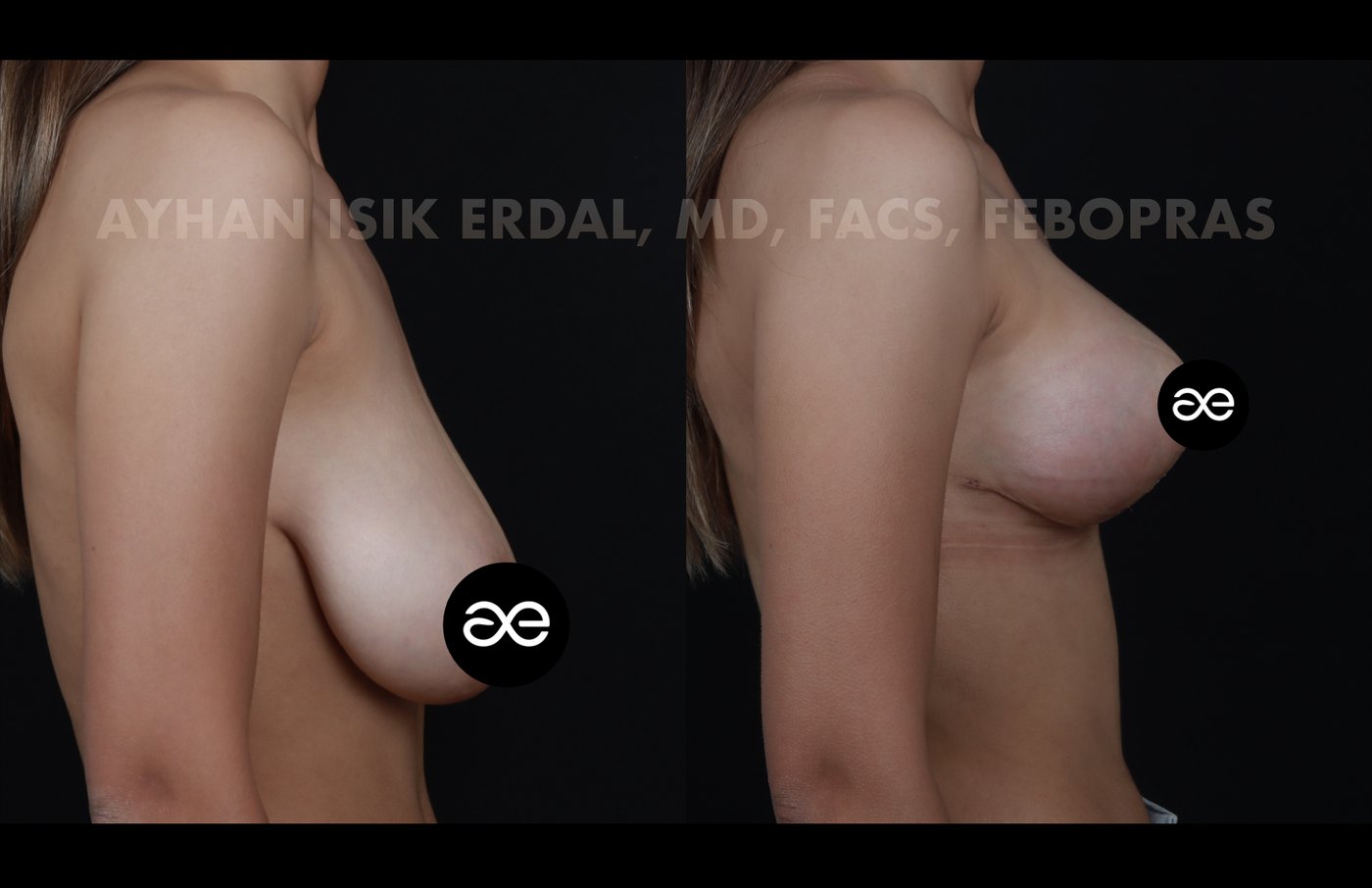 Case 3 lateral view - pre-op and 2 months post-op