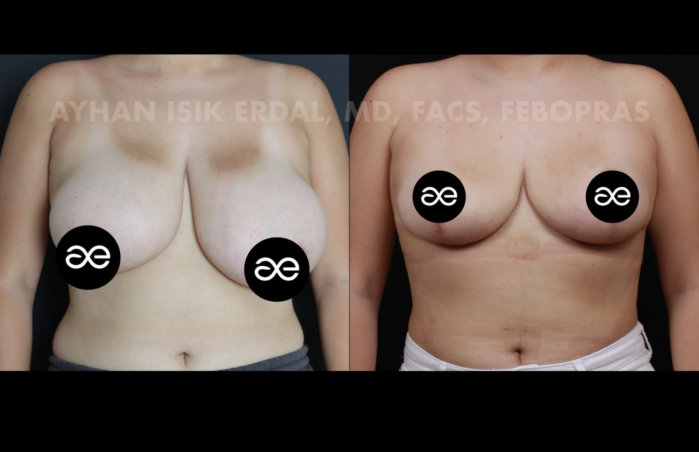 Case 5 frontal view - pre-op and 2 months post-op