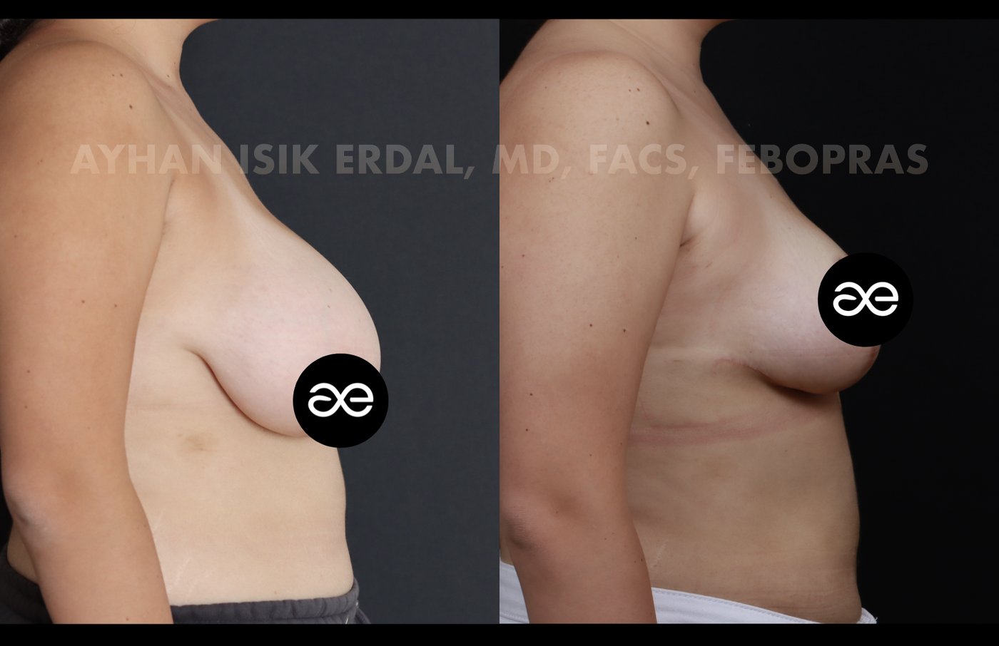 Case 5 lateral view - pre-op and 2 months post-op