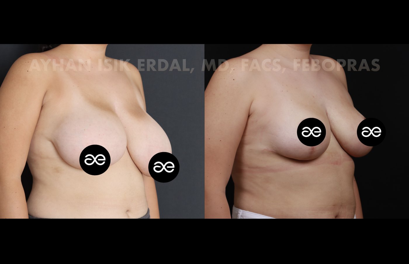 Case 5 oblique view - pre-op and 2 months post-op