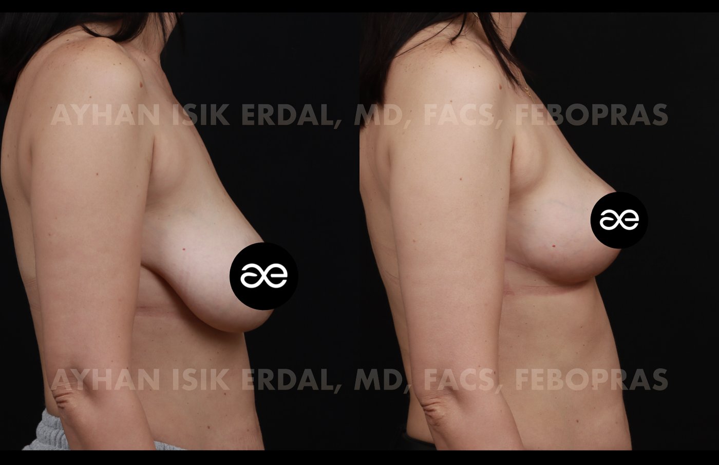 Case 6 lateral view - pre-op and 2 months post-op