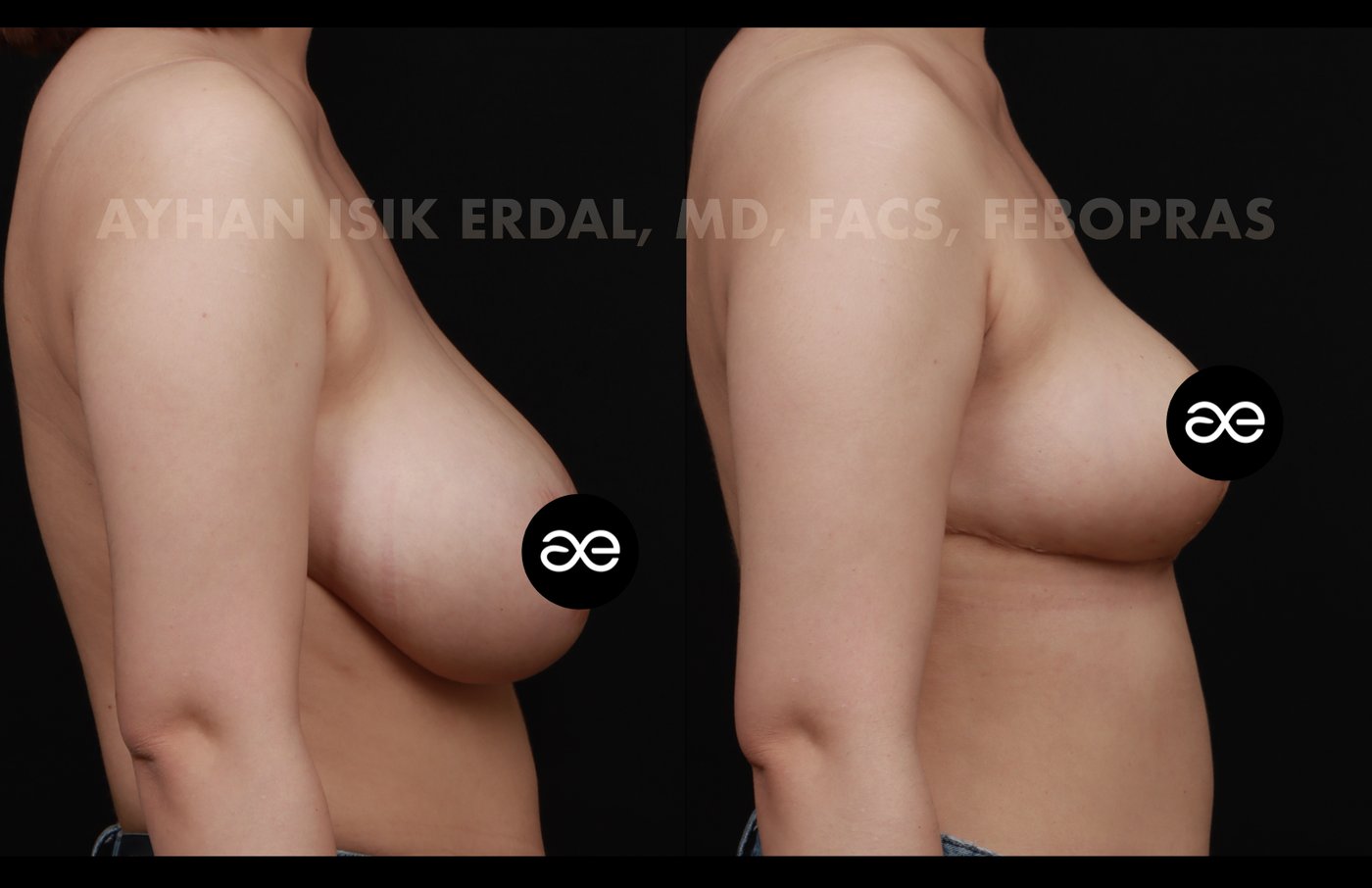 Case 7 lateral view - pre-op and 2 months post-op