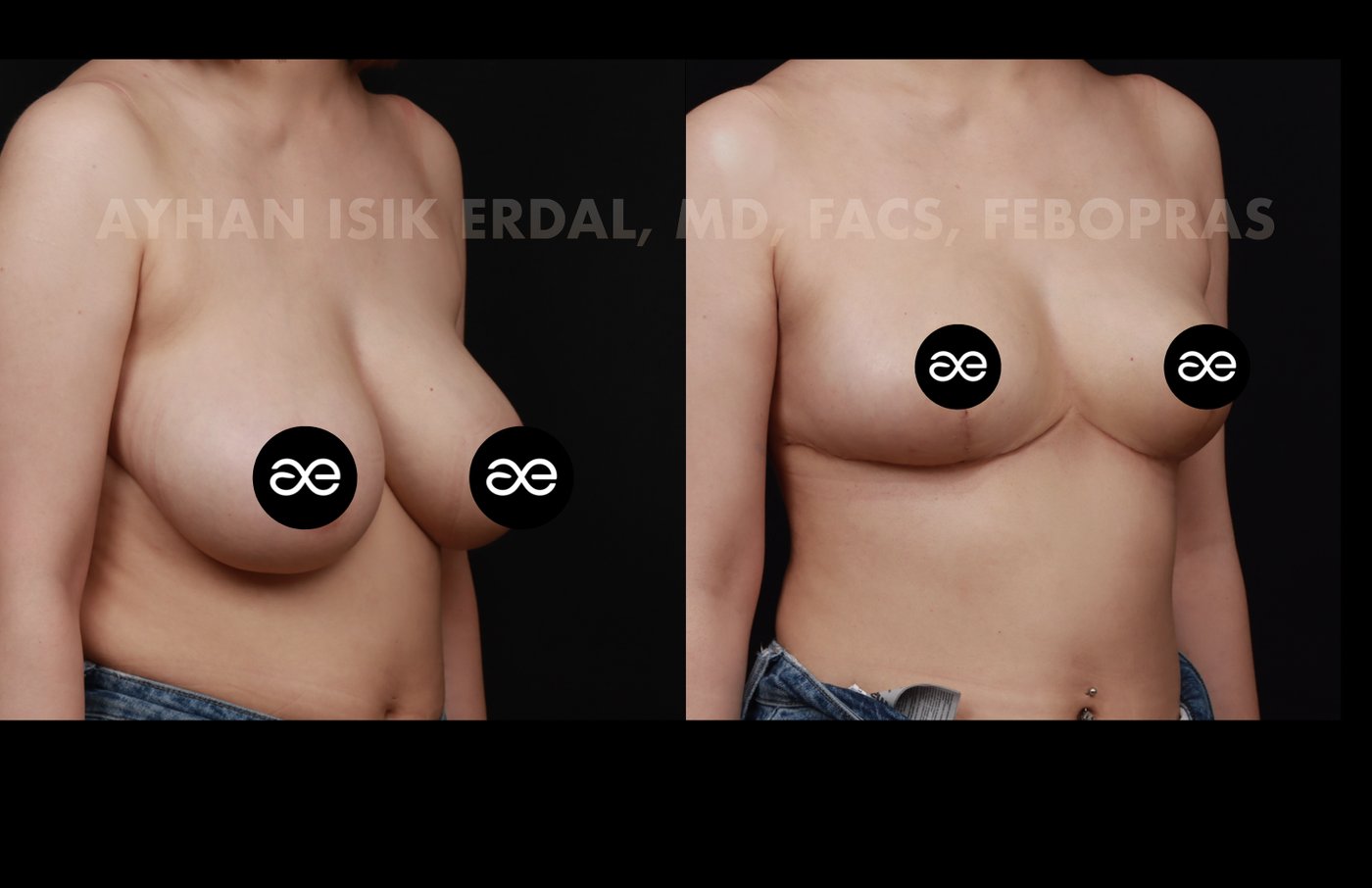 Case 7 oblique view - pre-op and 2 months post-op